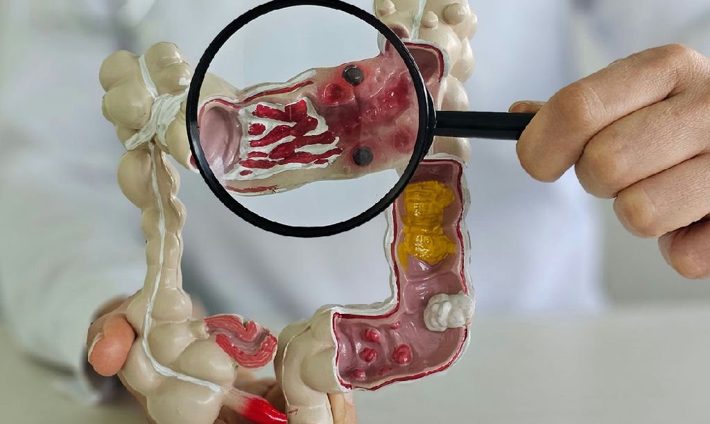 Incidência de doenças inflamatórias intestinais quintuplica no Brasil em treze anos