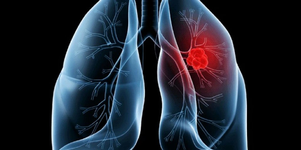 Adenocarcinoma pulmonar: entenda a condição diagnosticada no Papa Leão